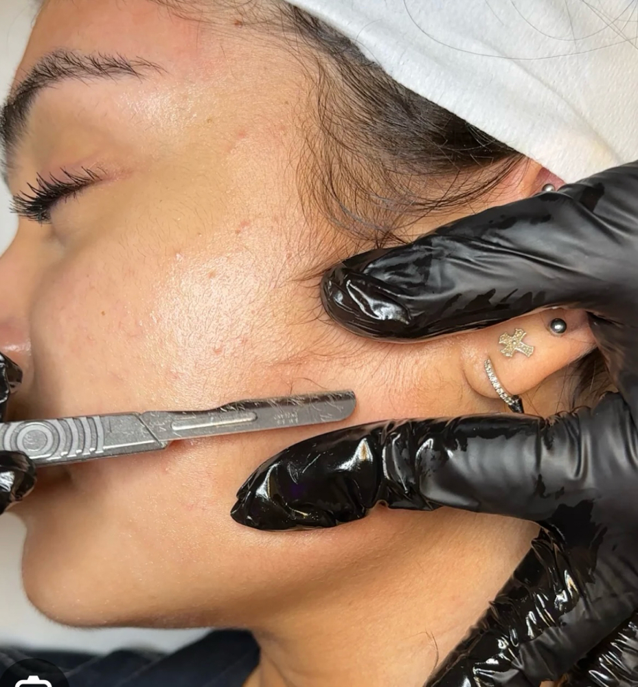 Dermaplaning