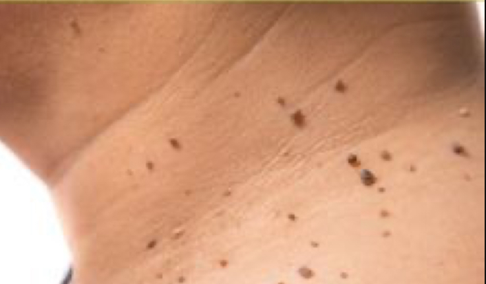 Skin Tag Removal at Tiny Touch up’s,LLC in Palm Springs, FL