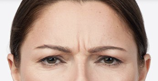 Frown Lines/ Glabellar Lines/ 11s