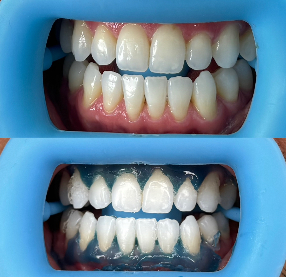 Teeth Whitening