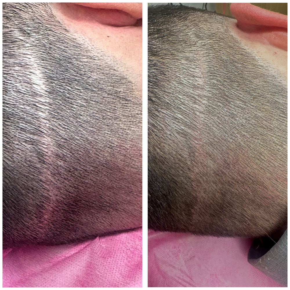 FUT Scalp Scar Coverup