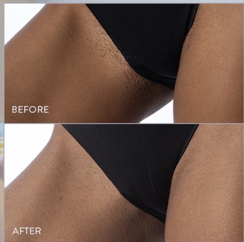 Bikini Line Laser Hair Removal