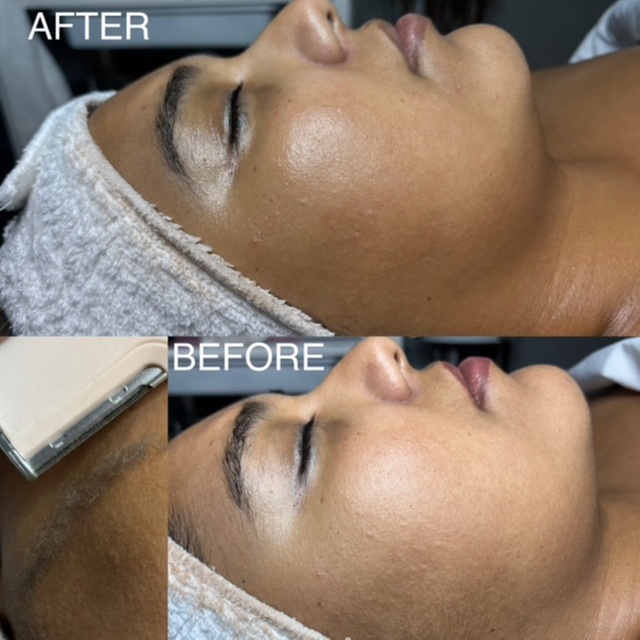 Radiance Dermaflash Facial 30 min at BK Skin & Brow Co. in Saint Charles, IL