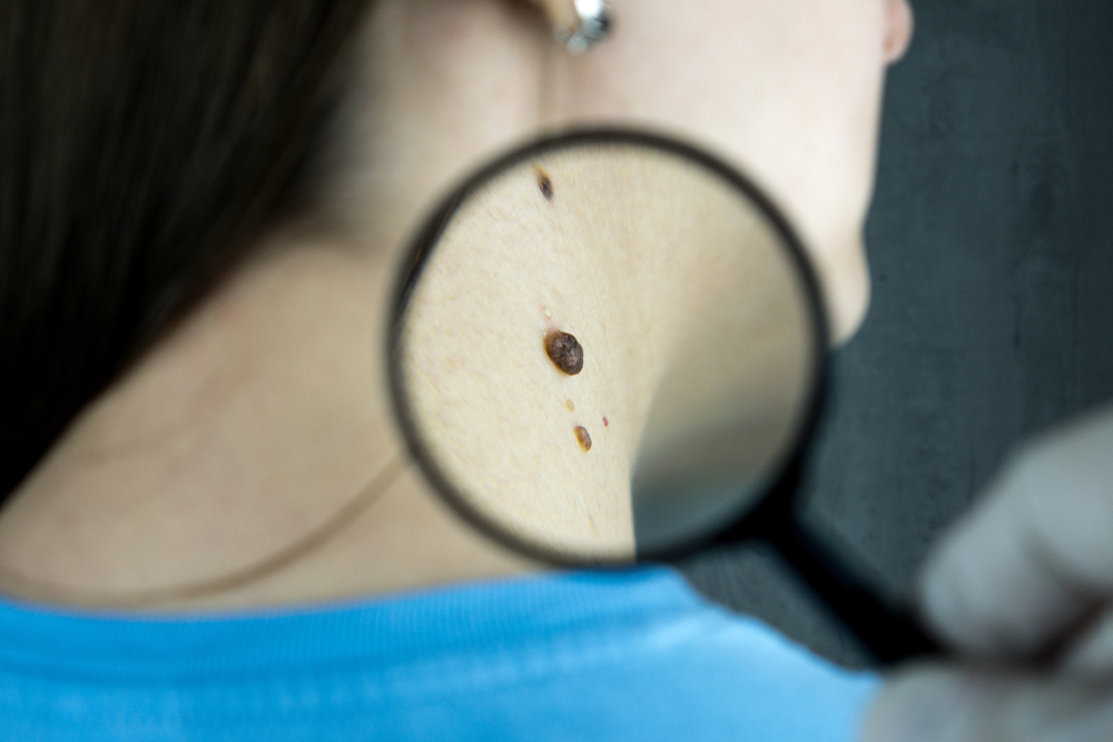 Skin Tag Removal