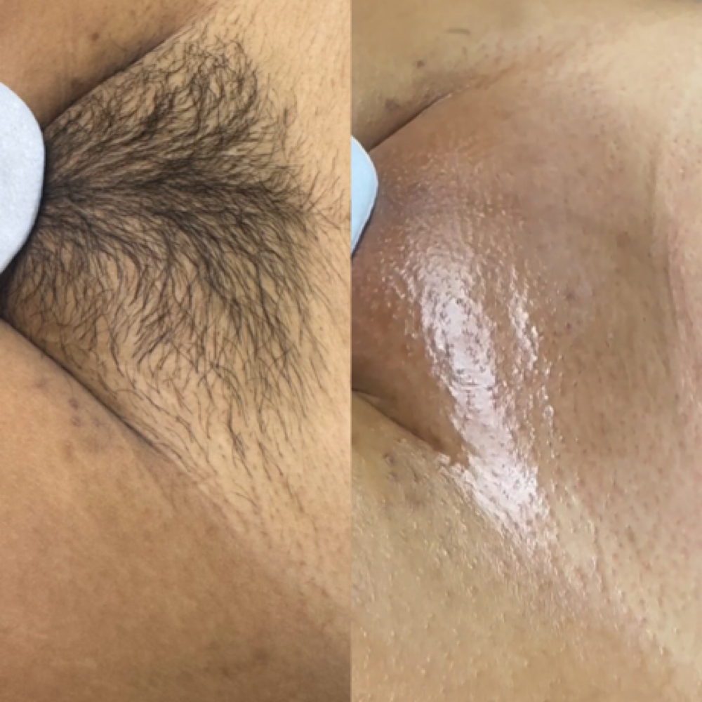 First Time Brazilian Wax at Waxxaholics Beauty & Body in Grand Prairie, TX