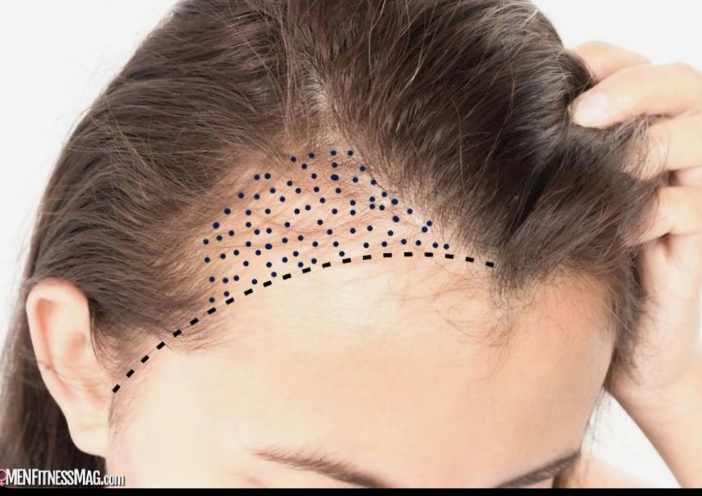 Scalp Microblading