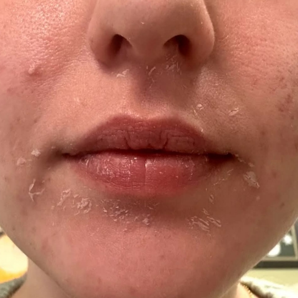 Image Peels at Andrea Godsey in Mesa, AZ