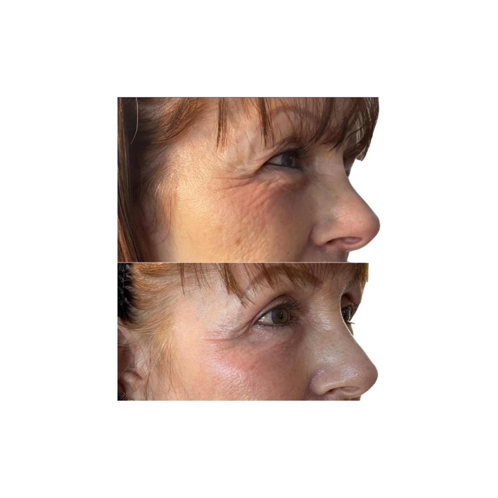 Anti-Aging RF Facial