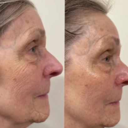 Tightening & Lifting V-Tox Mask at Skin Love Worthington in Worthington, OH