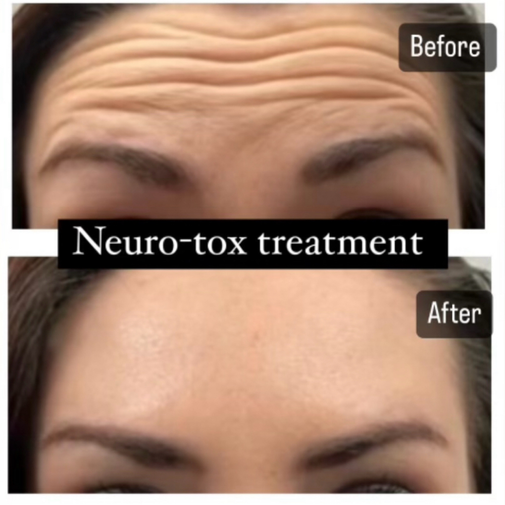 Botox By Area at Holistic Beauty in View On Website, NY