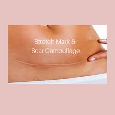 Stretch Mark & Scar Camouflage