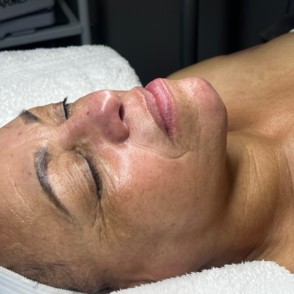 PCA Chemical Peel at Radiant Eyes & Aesthetics in Petal, MS