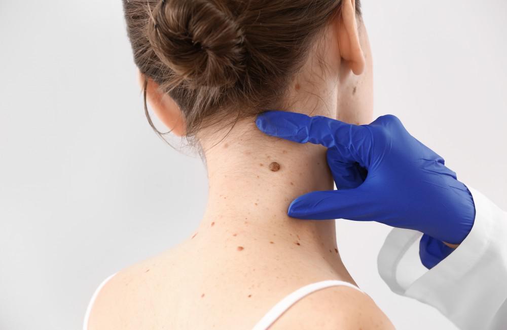 Skin Tag Removal