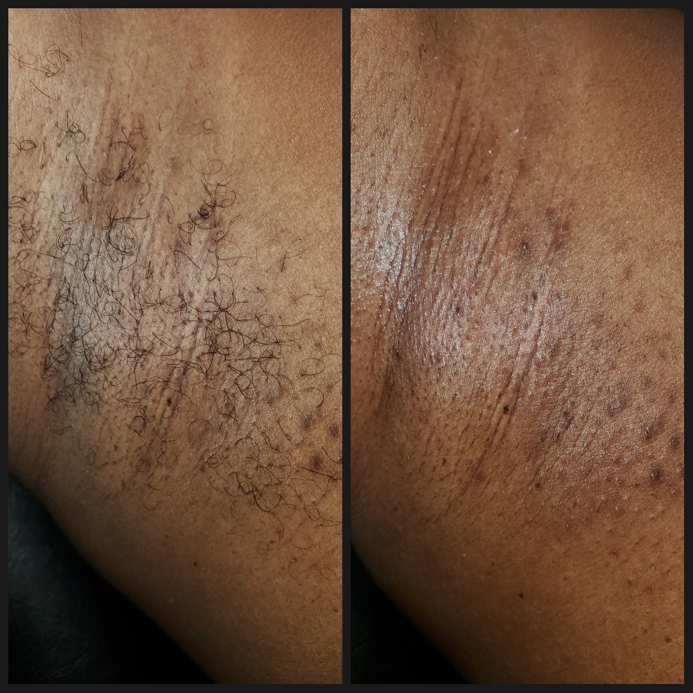 Underarm WAX
