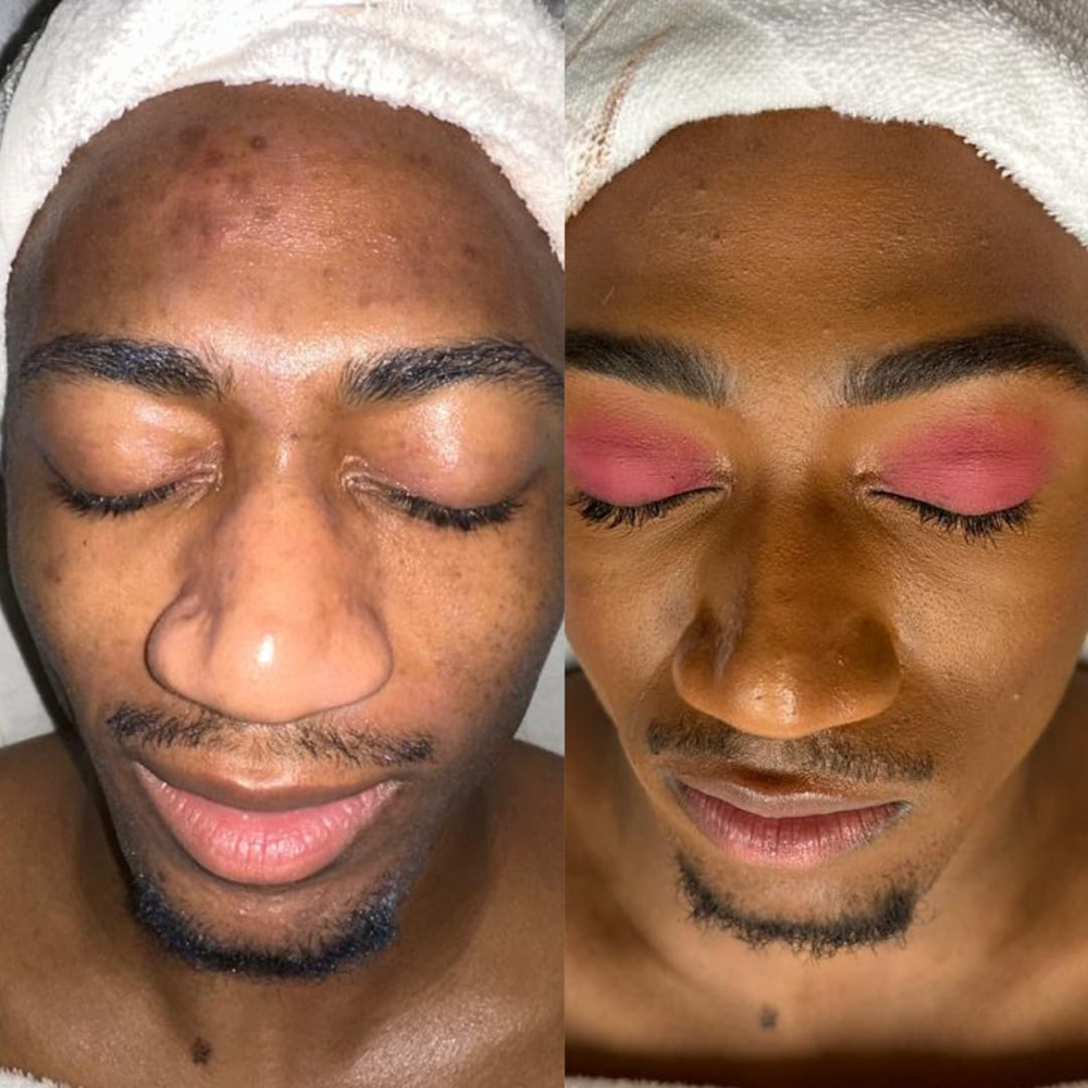 HydraFacial Treatment