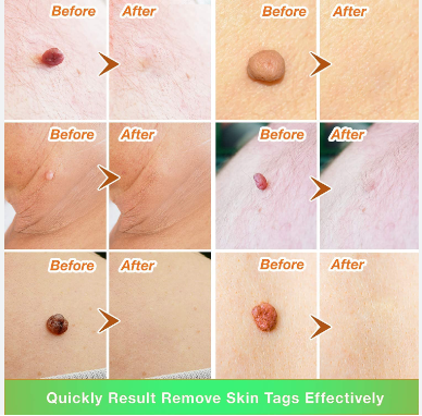 Skin tag removal