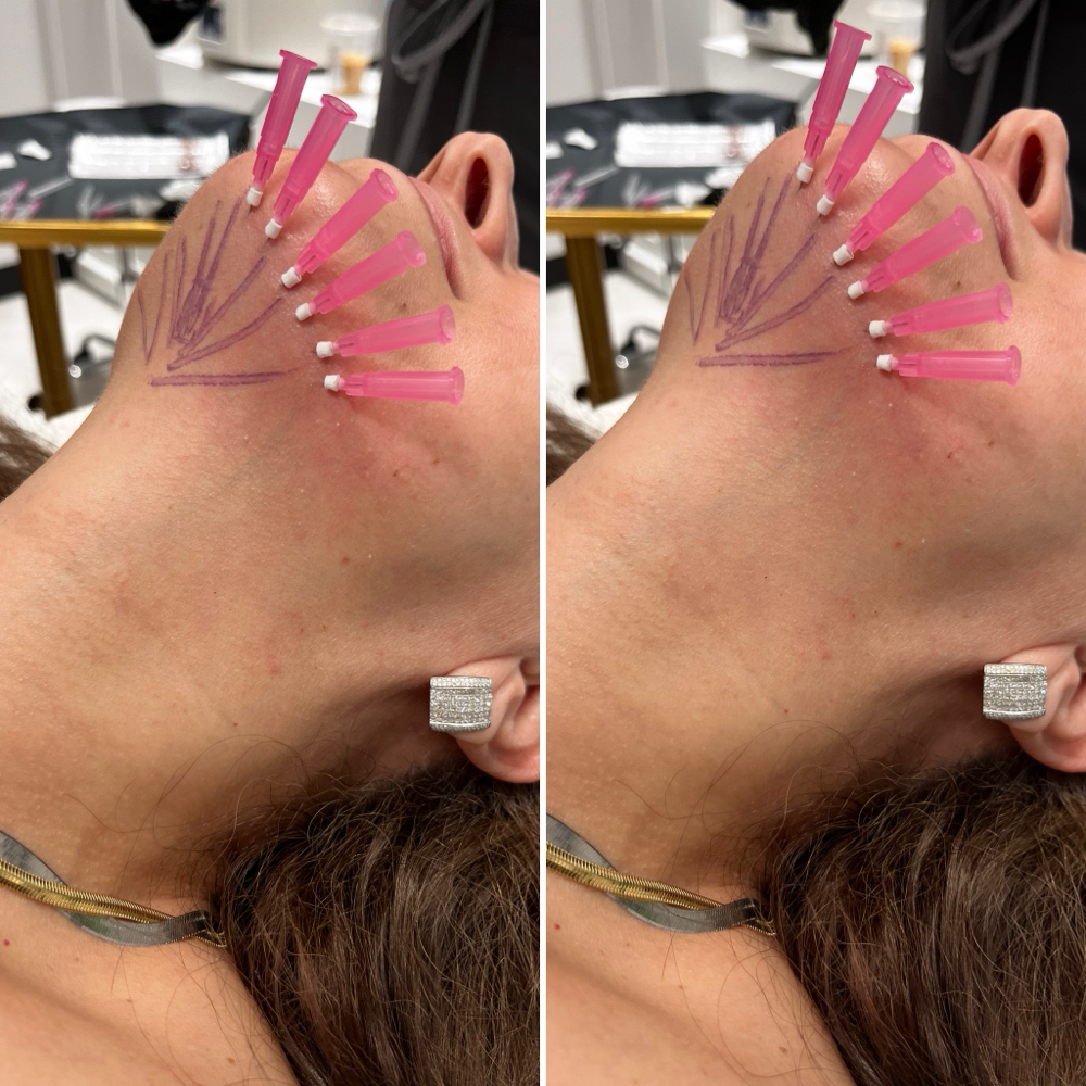 PDO Threads For Submental Chin