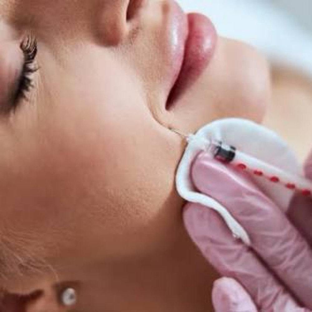 NASOLABIAL FOLDS FILLER at Irena Studio & Academy in McAllen, TX