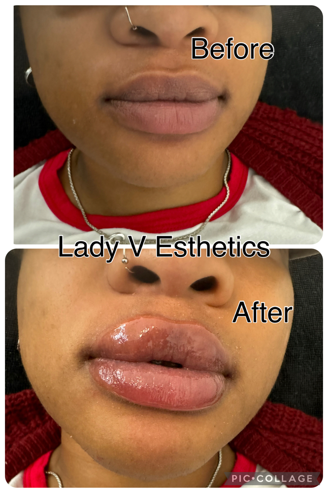 Hylaron Lip Filler 2ML