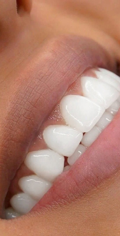 30 Minute Whitening Touch Up