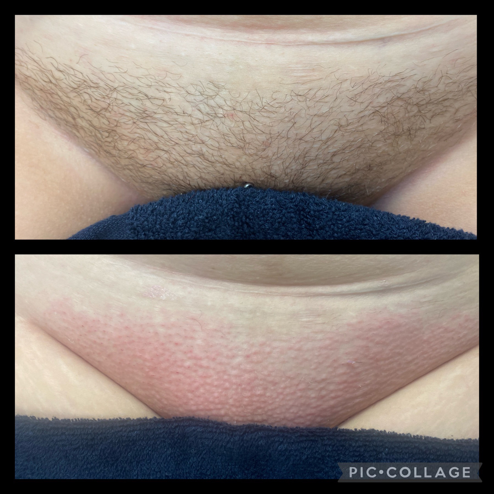 Brazilian wax