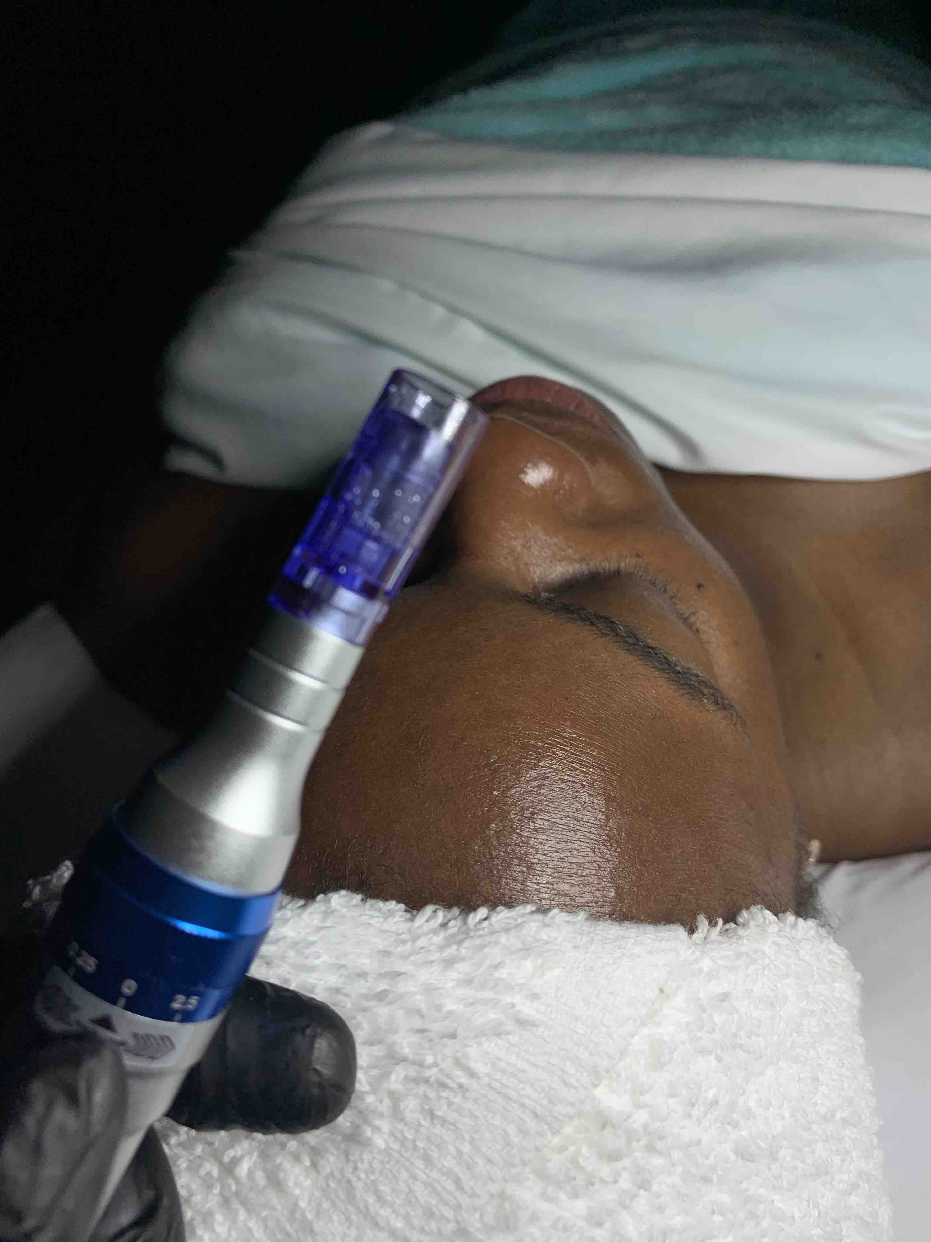 Nano Needling