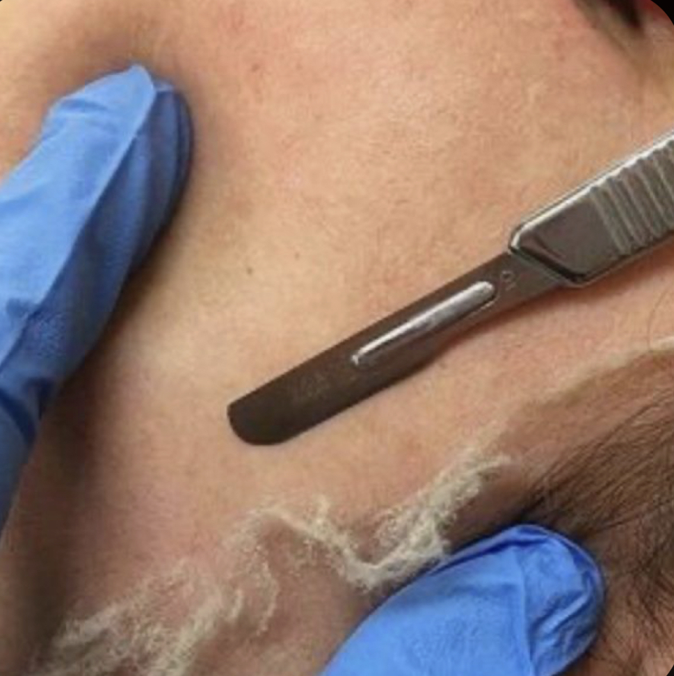 Dermaplaning