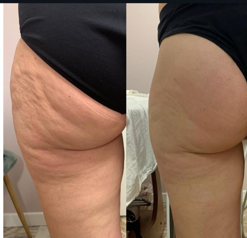 Lymphatic drainage leg at cryo Body Contour in Riverdale, GA