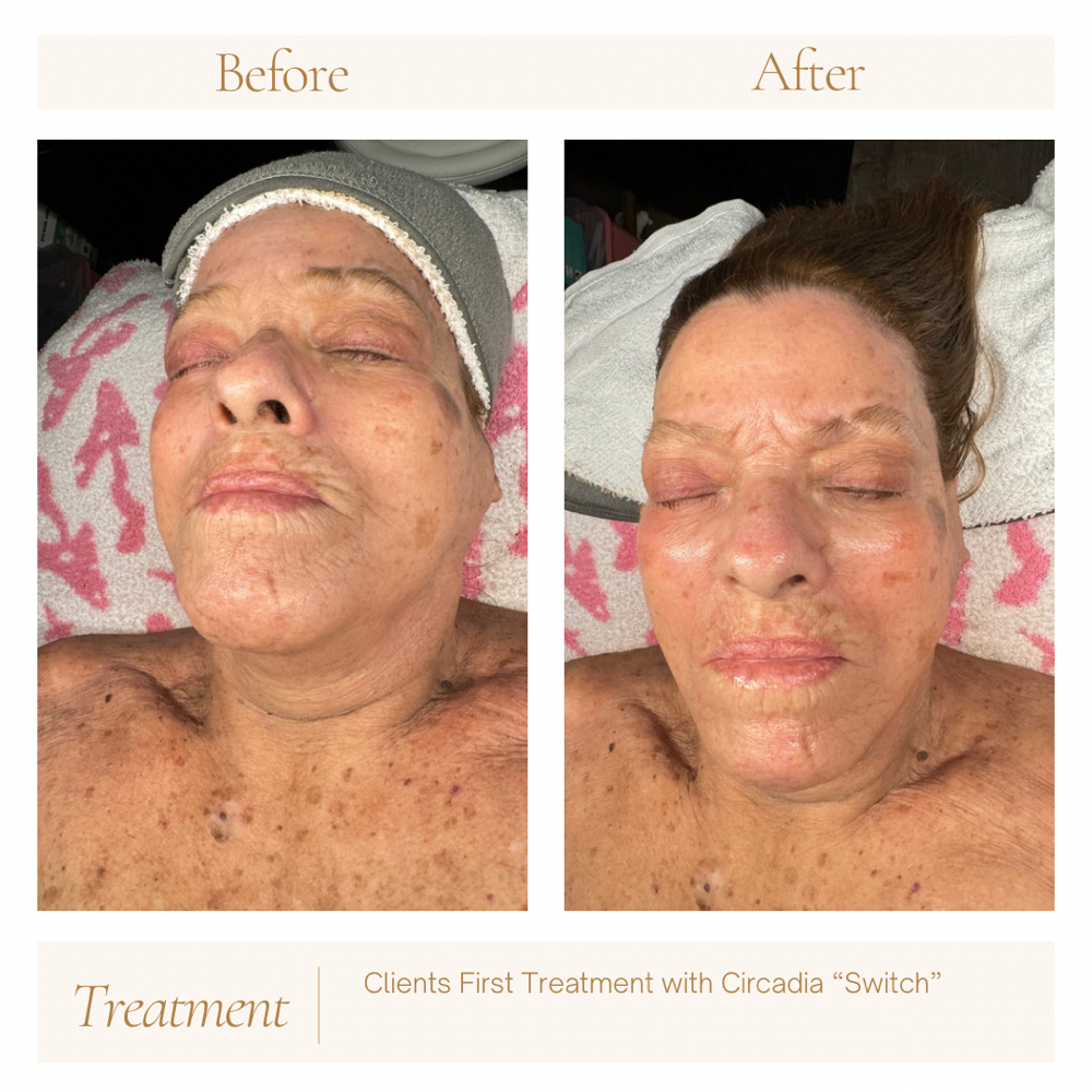 Antiaging Dermal Renewal Treatment