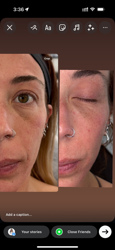 PRP Under Eye Restore