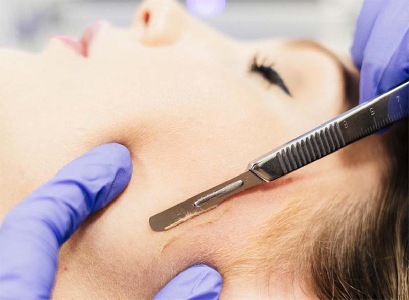 Dermaplaning treatment at Lakeside Studio and Spa in Fort Wayne, IN