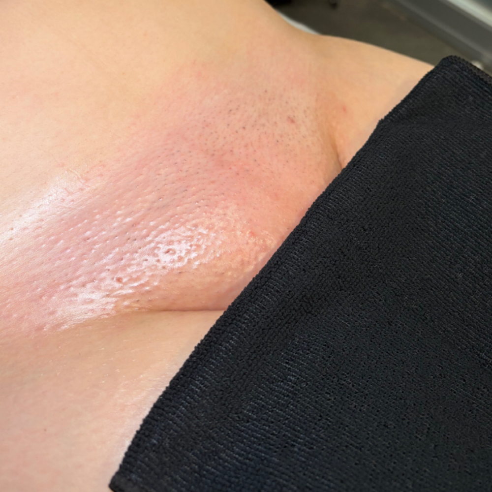 Brazilian wax at You Esthetics in Salem, MA