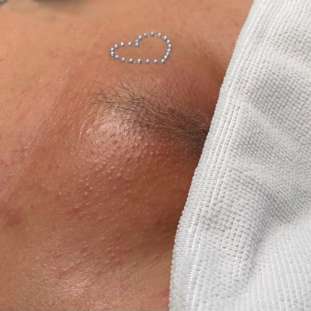 Brazilian wax at You Esthetics in Salem, MA