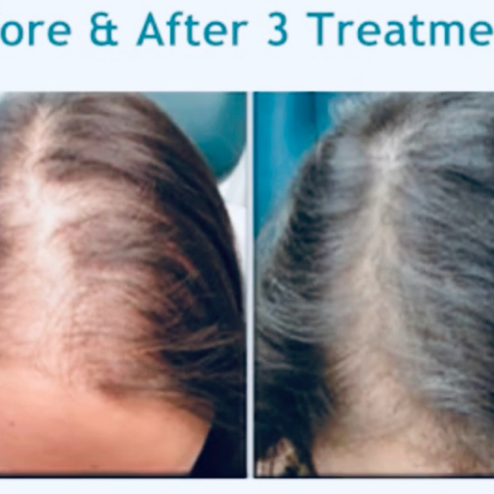 PRP Hair Restoration ($750 Value) at Glam & Glow MedSpa in Plano, TX