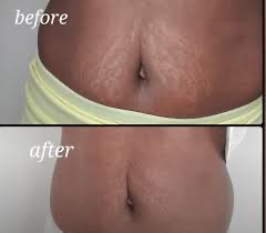 Stretch Mark Camouflaging