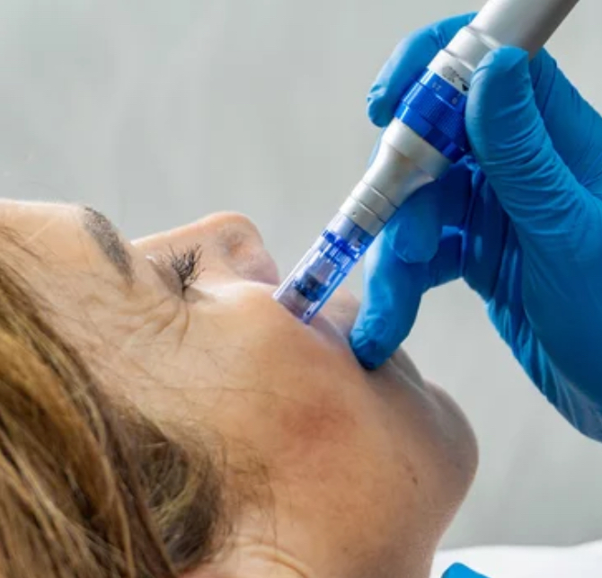 Microneedling