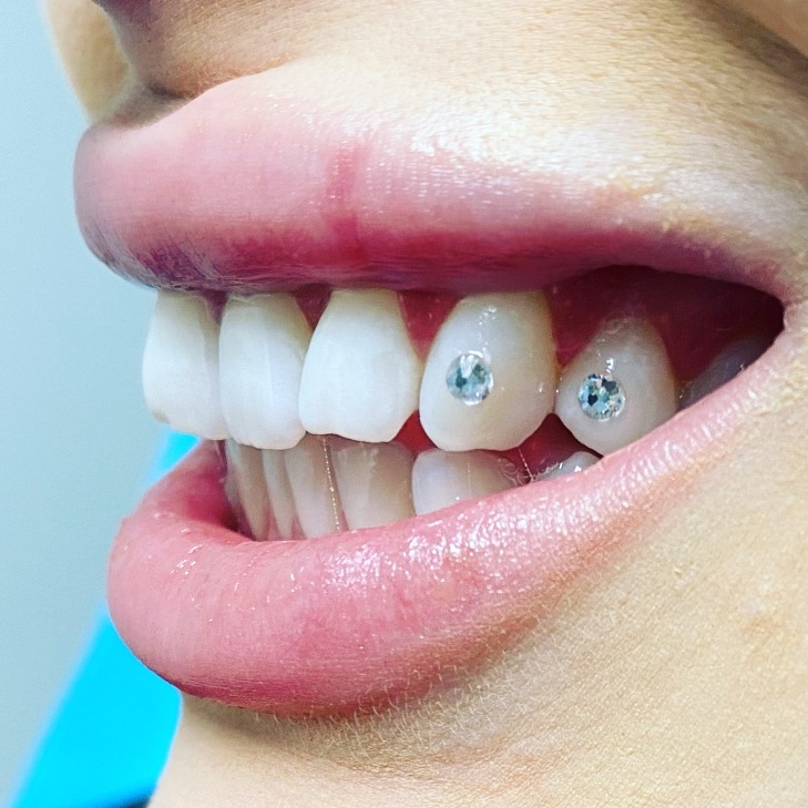 Tooth Gem