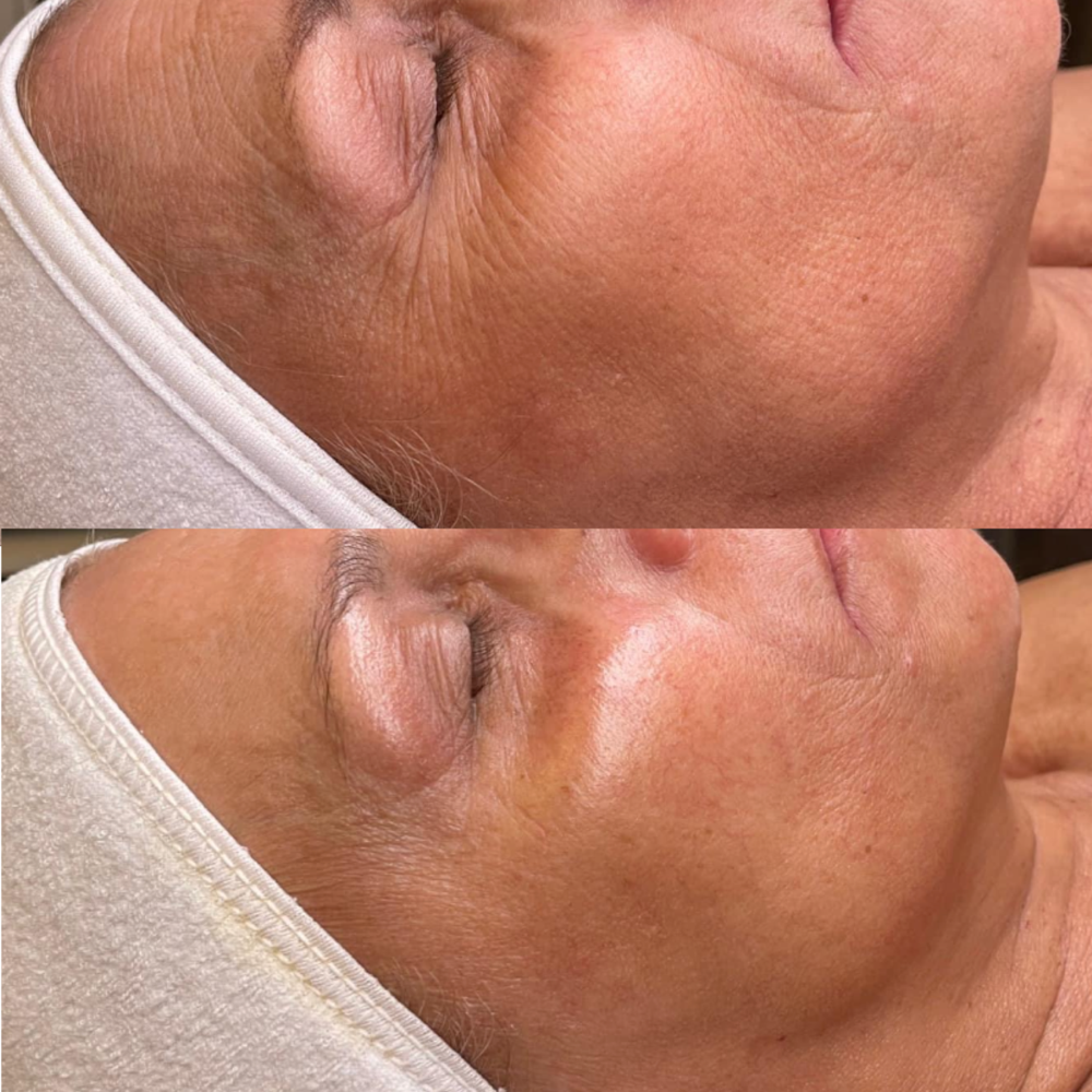 The Firming Facial