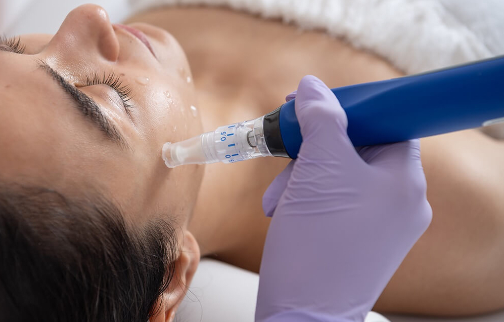 Microneedling Treatment