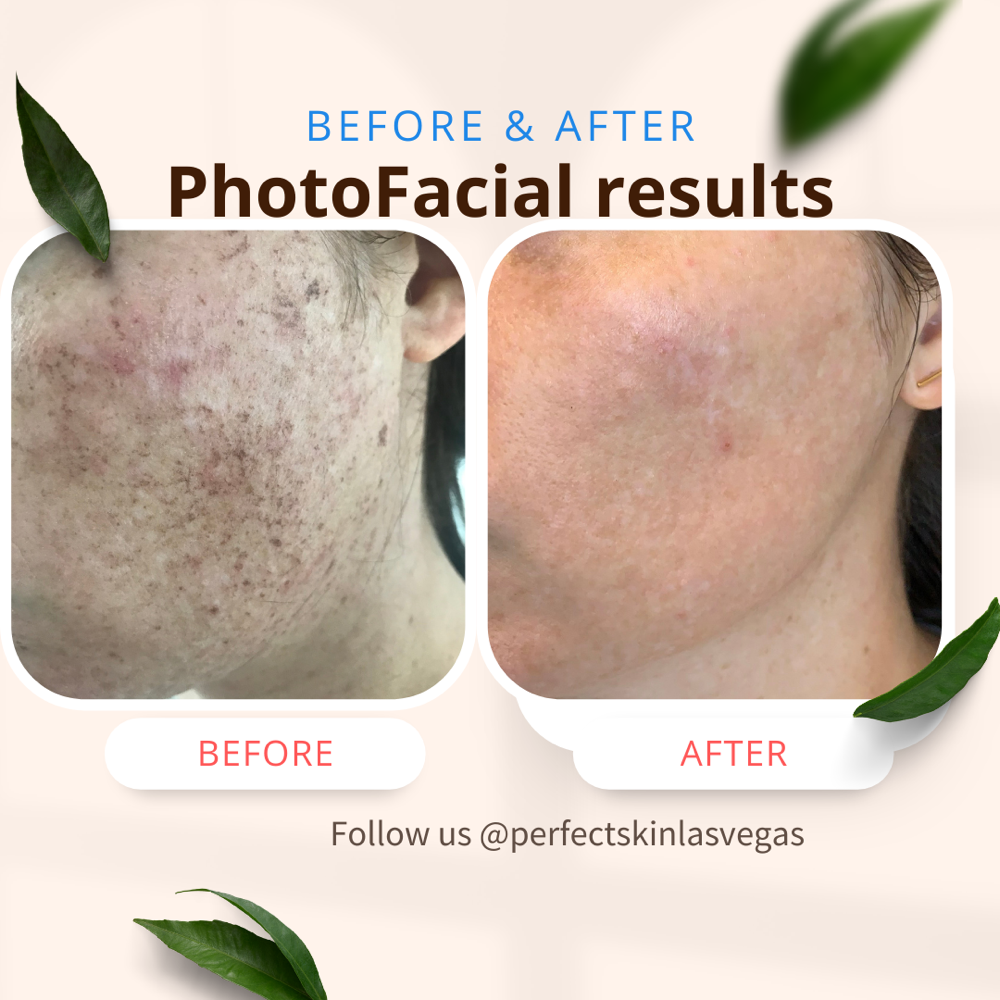 IPL Photofacial
