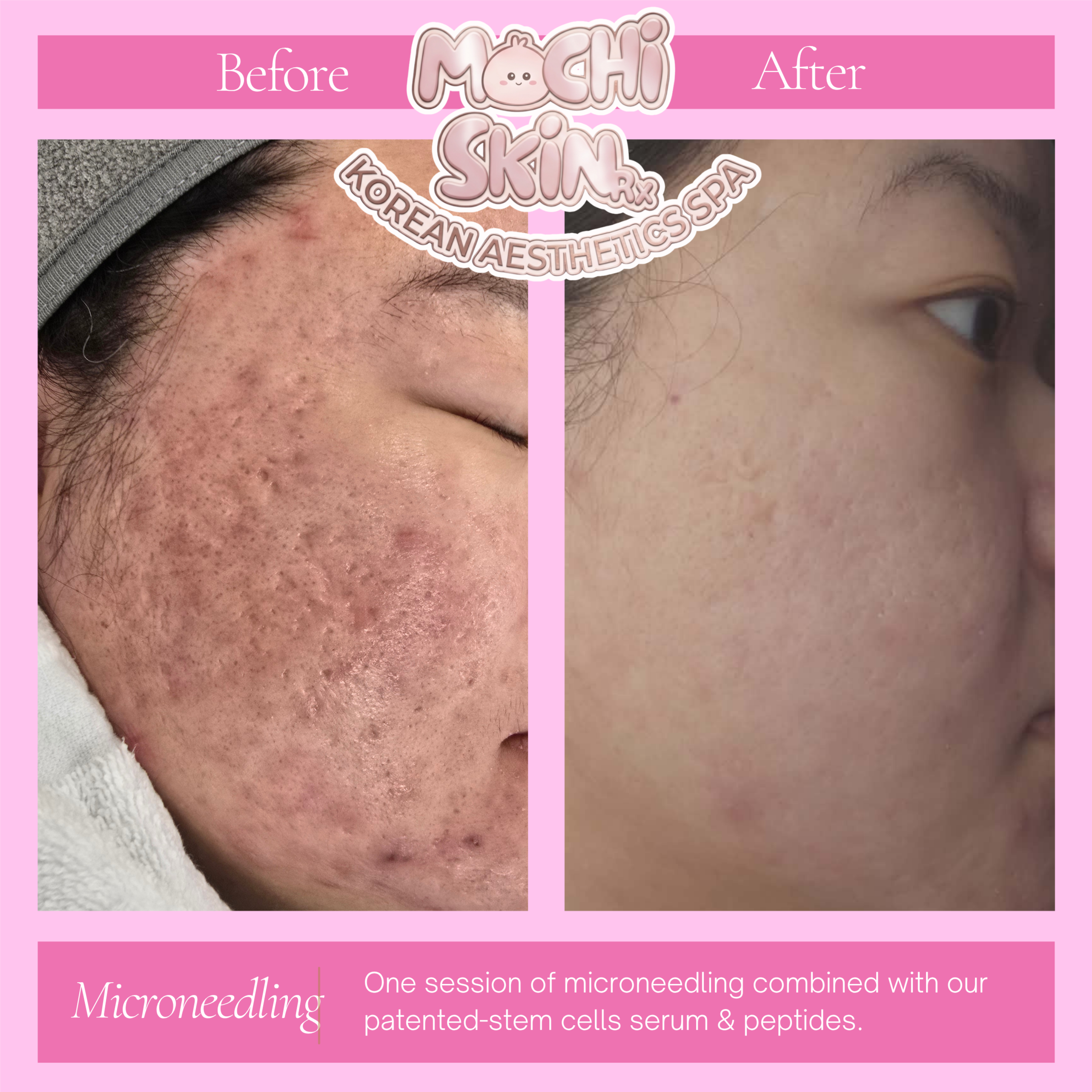 SkinPen Microneedling at Mochi Skin Rx in Roseville, MN