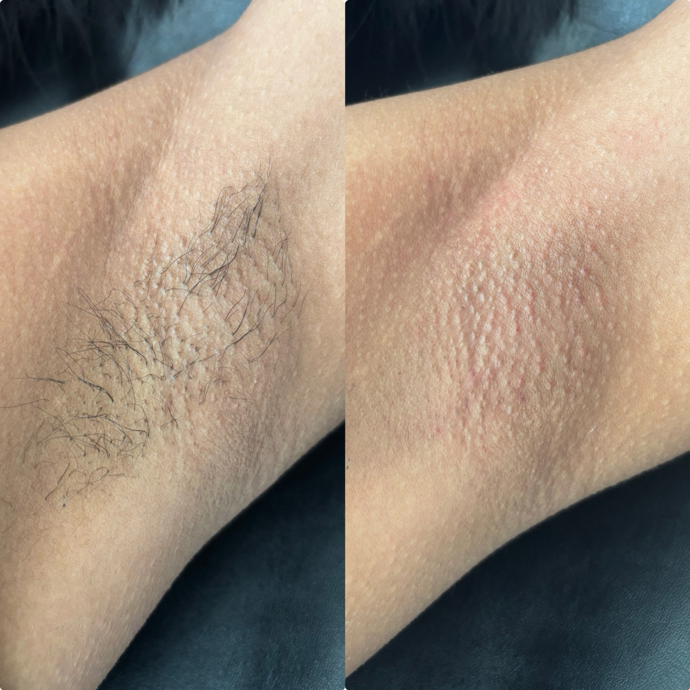 Underarms at The Aesthetix Lounge in San Clemente, CA