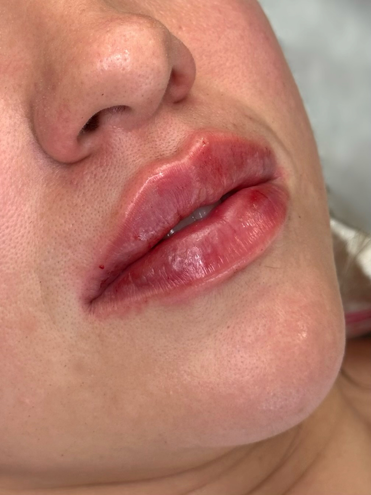 ✨August Lip Filler Special ✨