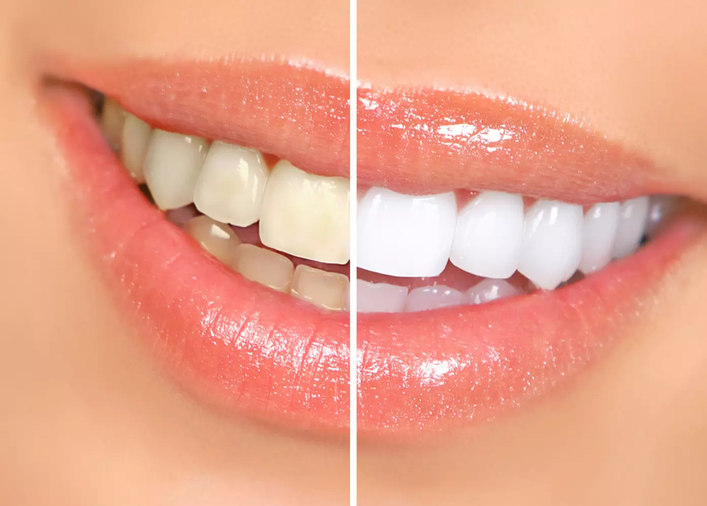 Teeth whitening at Shape Me Beauty Studio in Midland, TX