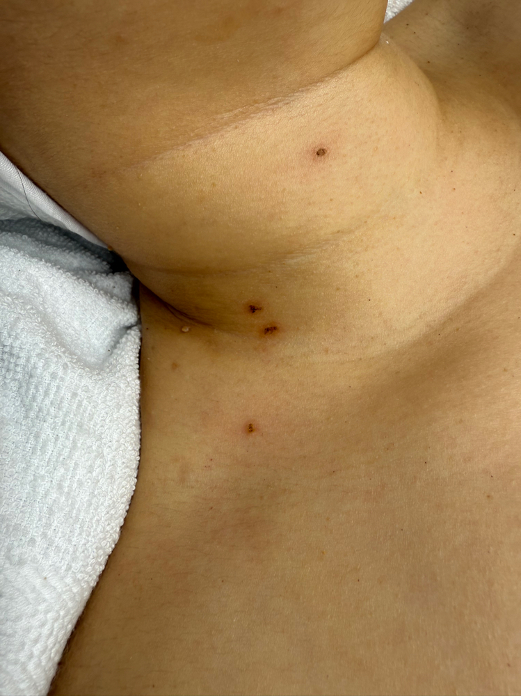 Extraccion De Lunares Berrugas at D&K Beauty&Spa in Newpor News, VA