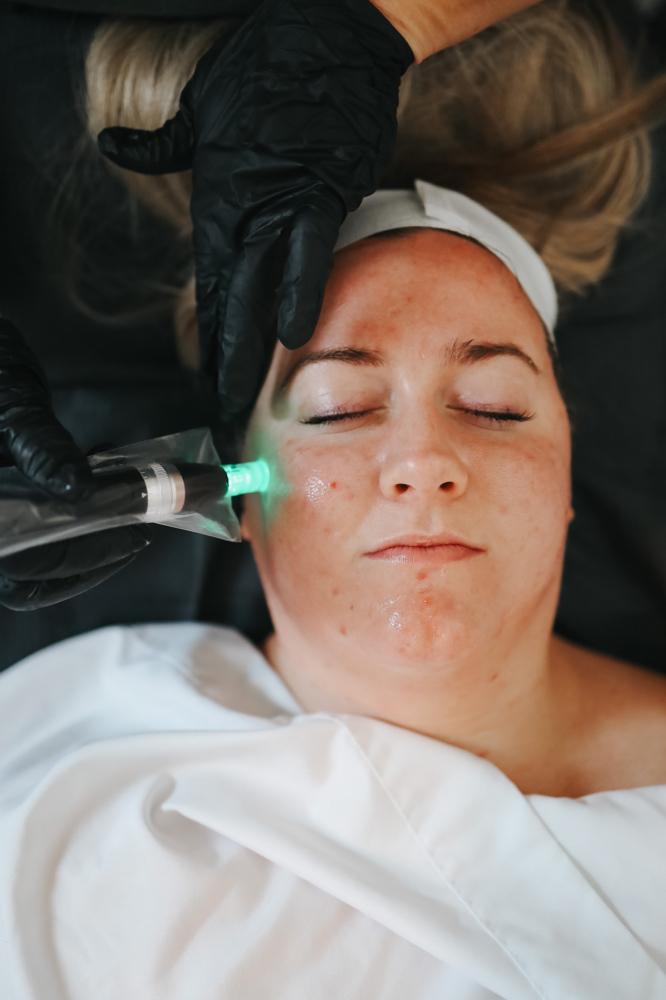 Microneedling Collegan induction