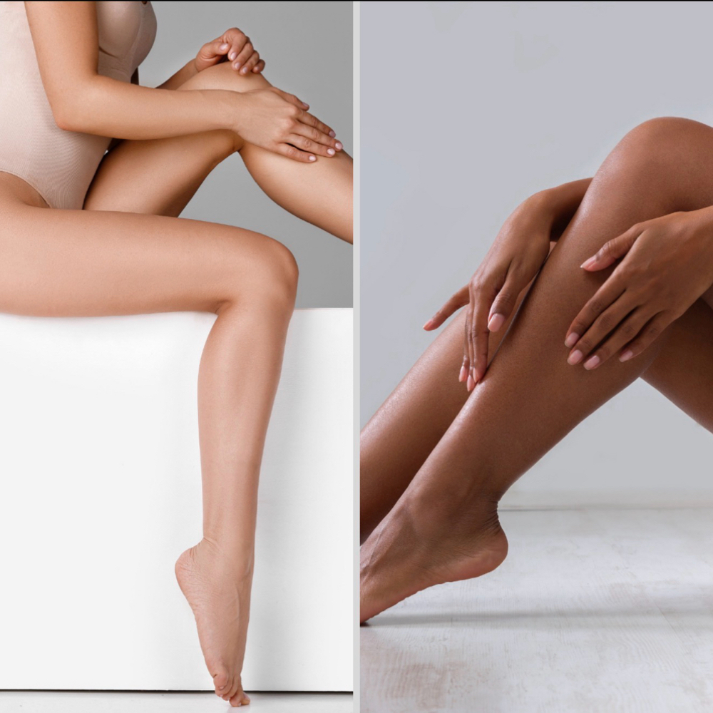 Full Legs Laser- One Session Only at SLS Laser Medspa in Ontario, CA