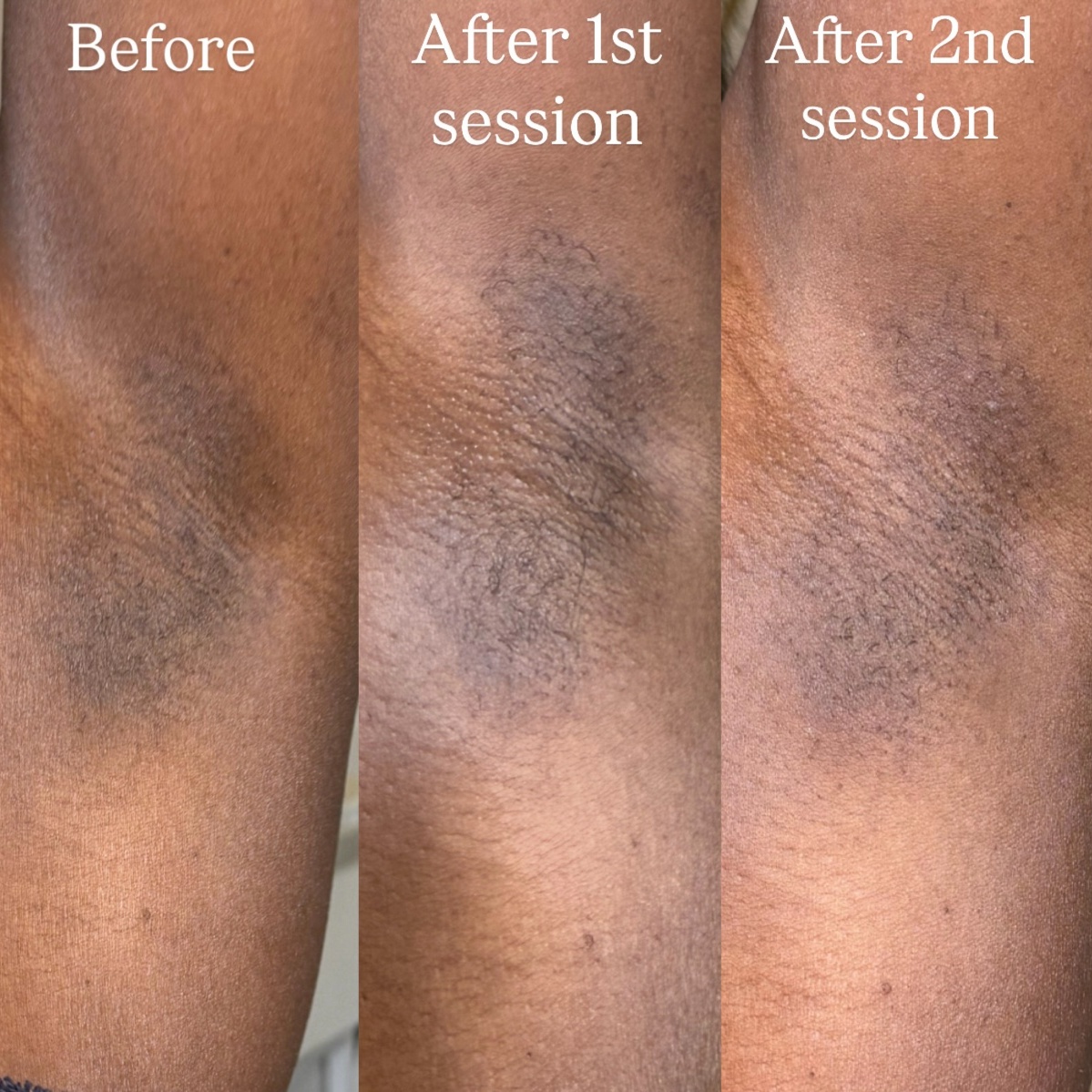 Intimate Bleaching Packages