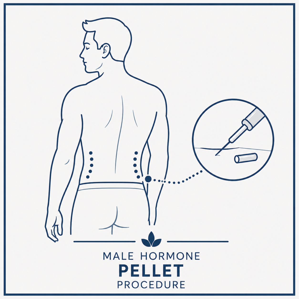 Male Hormone Pellet Procedure at Perrenia Wellness in Shallotte, NC