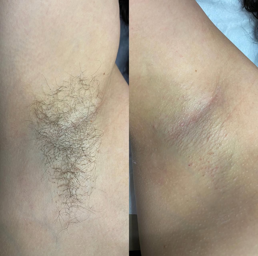 Underarm Wax